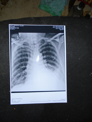 According to the doc, this x-ray suggests I have pneumonia, but not yet in a big way.